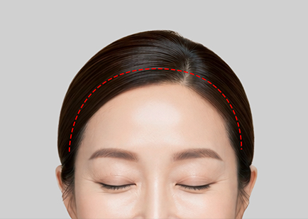 Coronal Forehead Lift - Sayatan Kulit Kepala