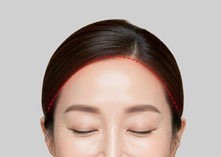 Forehead Reduction Lift - Sayatan Hairline