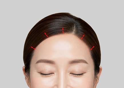 Endoscopic Forehead Lift - Sayatan Minimal di Dalam Hairline