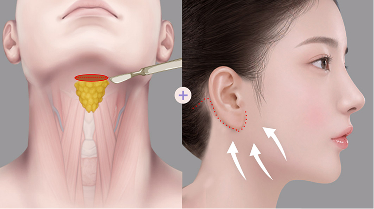 All-in-One Pengencangan Otot Double Chin + Mini Facelift