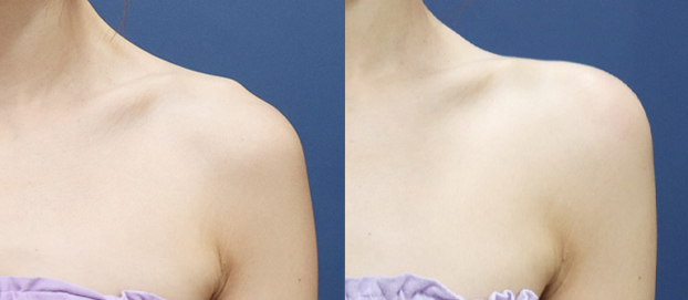 Shoulder filler dengan traptox sebelum dan sesudah