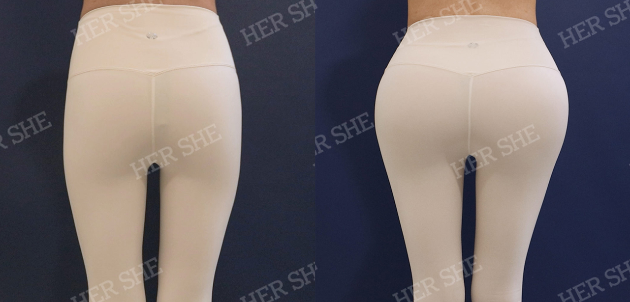 Perbandingan sebelum dan sesudah Pelvic Filler