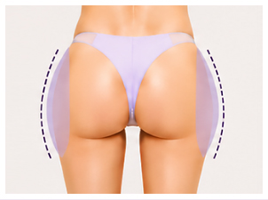 Memperbaiki Garis Pelvis Datar & Volume