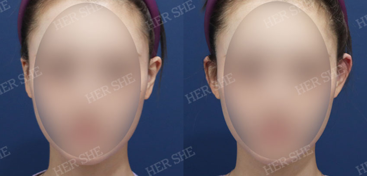 Perbandingan sebelum dan sesudah Pelvic Filler