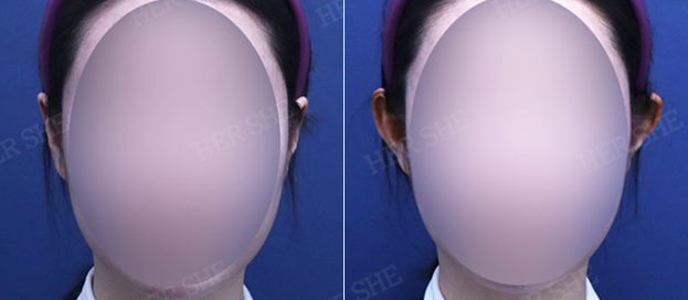 Sebelum & Sesudah Elf Ear Filler + Masseter Toxin