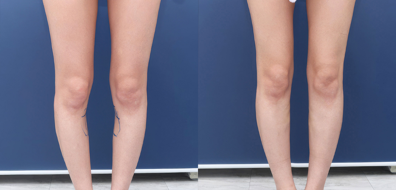 Perbandingan Sebelum & Sesudah Leg Filler
